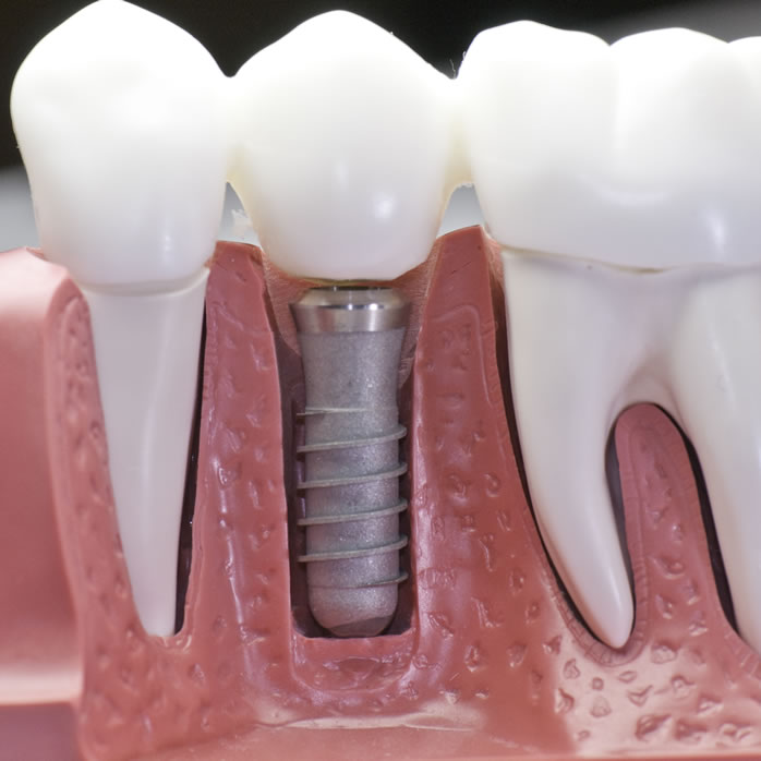 dental implant