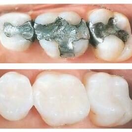 composite-fillings-4