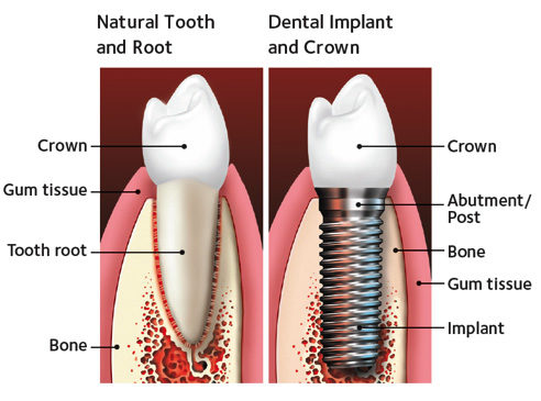 Dental Implant Process