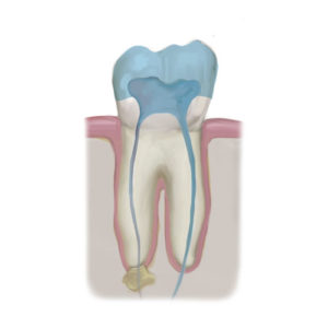 dental service - root canal