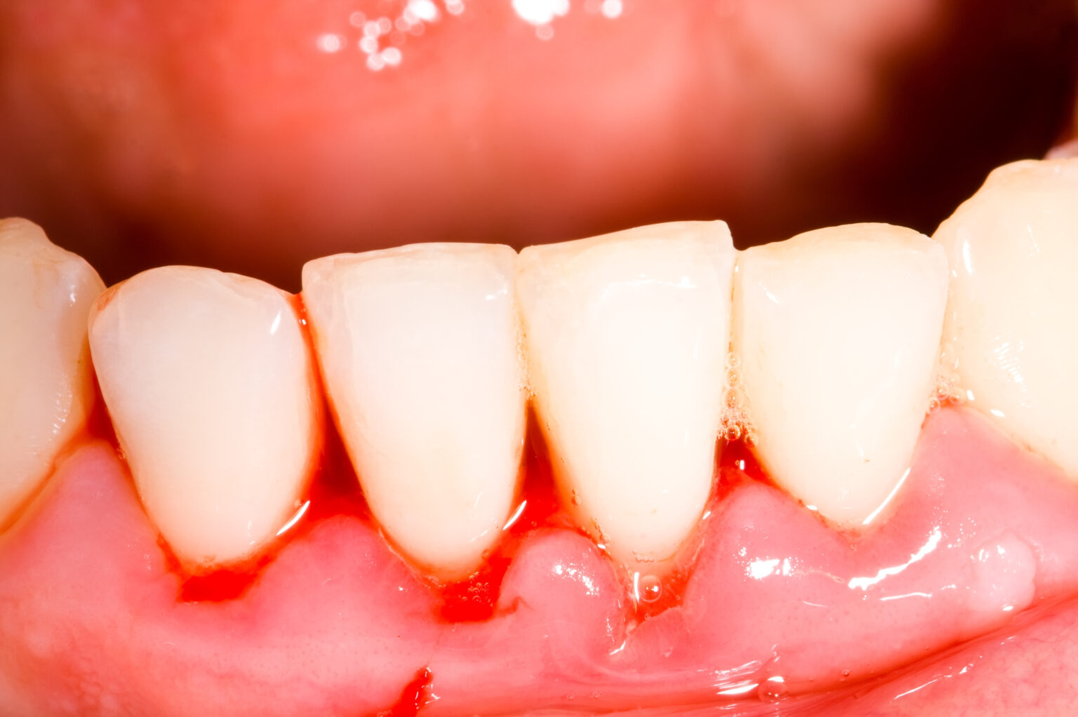 Periodontal Maintenance vs. Routine Cleaning Dentist in Colleyville, TX